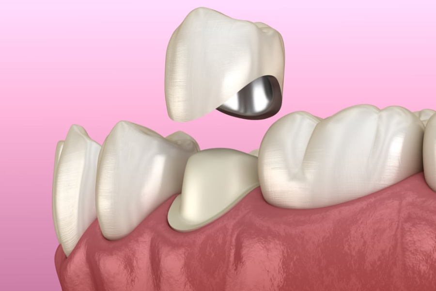 Dental Crowns Decoded