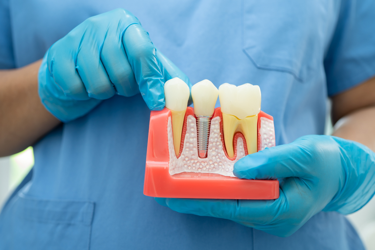Dental Implants Be Checked