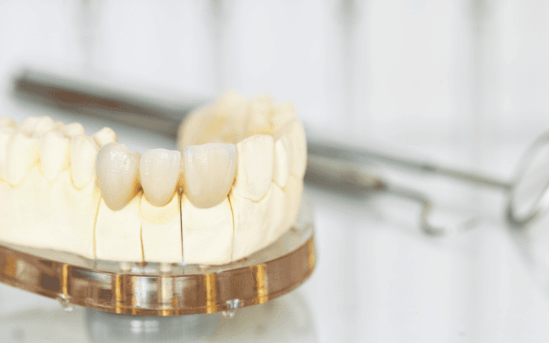 same day crowns revolutionize dental restoration