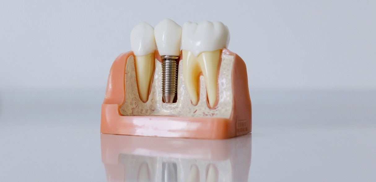 what to expect before during and after a dental implant procedure