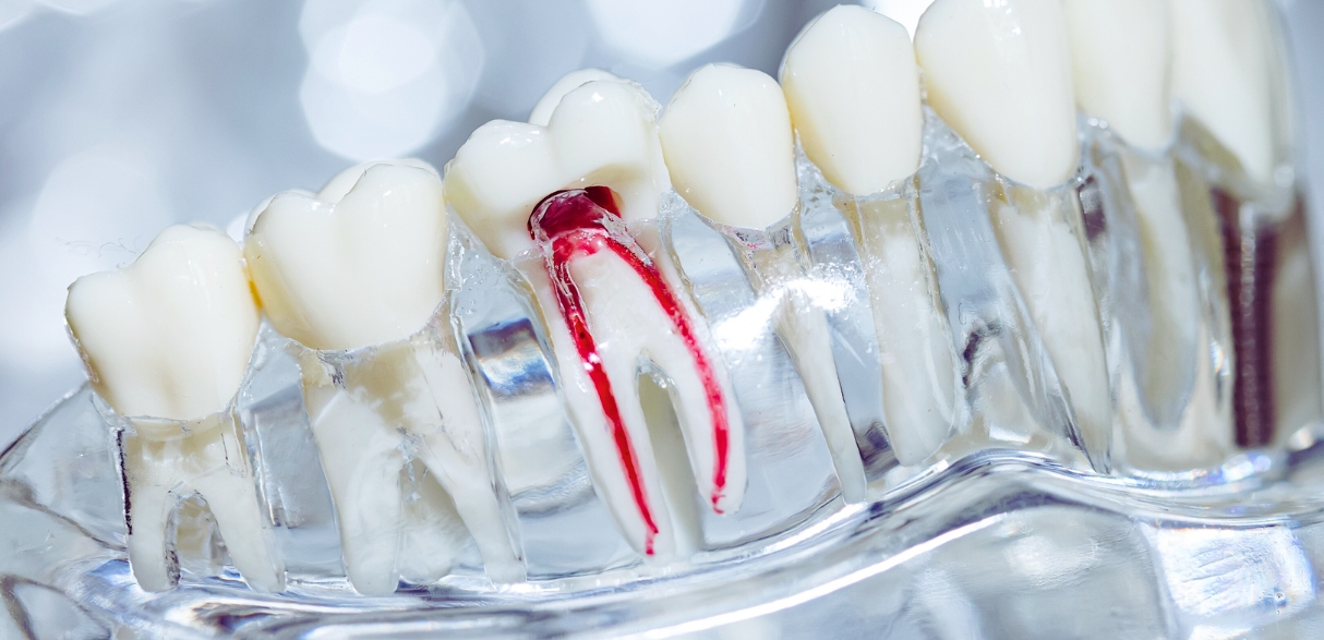 root canal for seniors is it the best choice for aging teeth