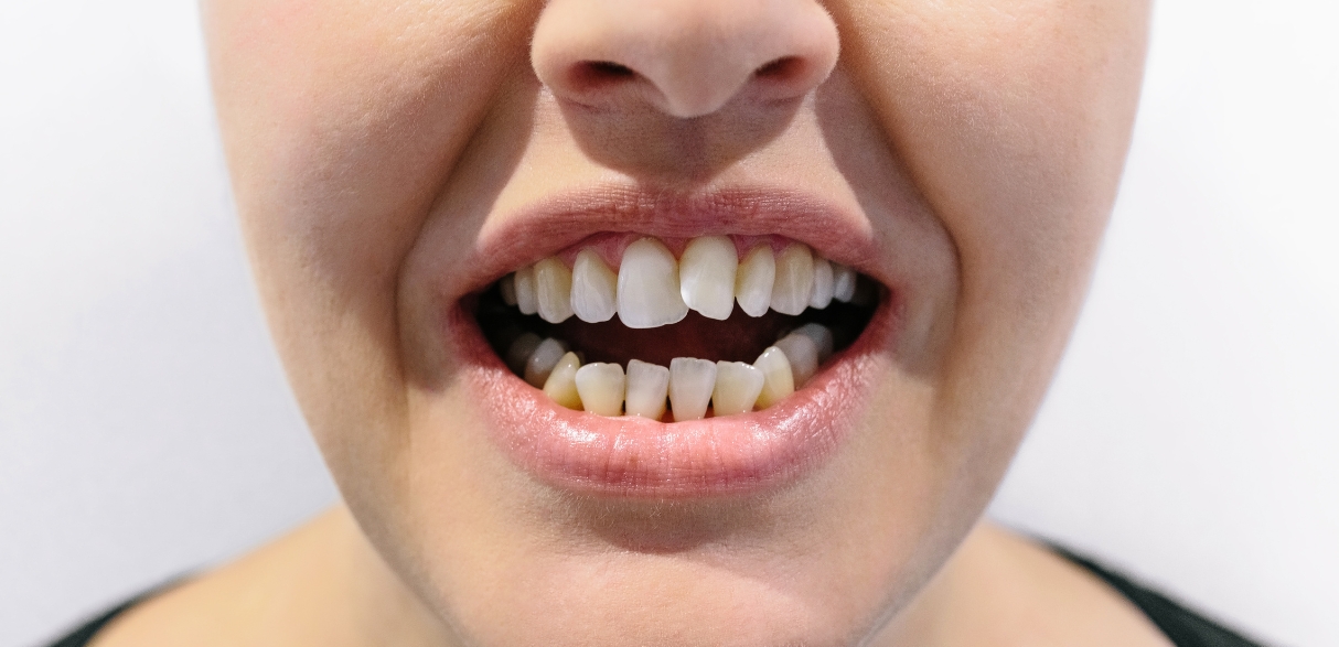 Can A Cosmetic Dentist Fix Your Crooked Teeth